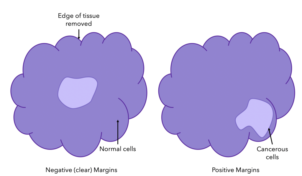 A Diagram Showing Breast Cancer Margins (Negative (clear) vs Positive)