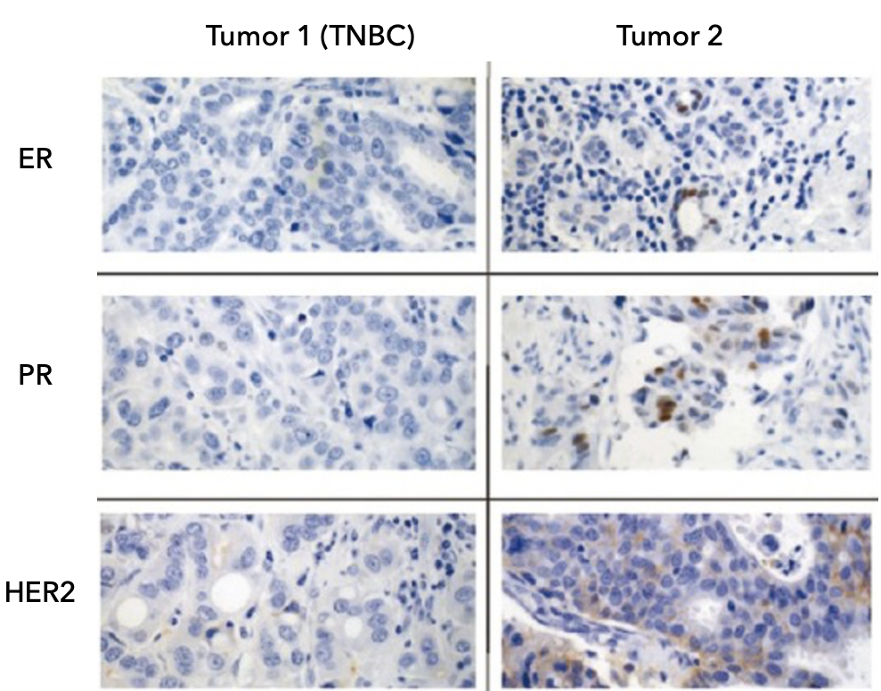 Triple Negative Breast Cancer Tumor cells