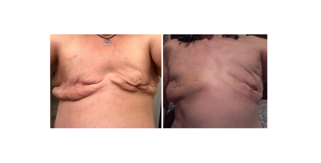 3 Month Update Prophylactic bilateral mastectomy with an aesthetic flat  closure 