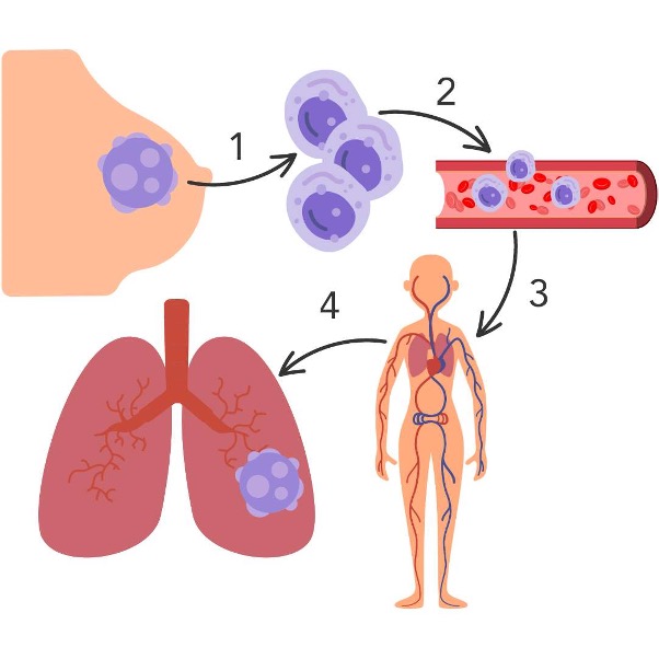 Breast cancer metastasis 